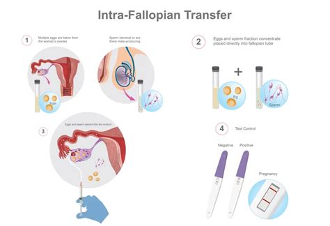 Gamete Intrafallopian Transfer Procedure Success Rate Cost And More