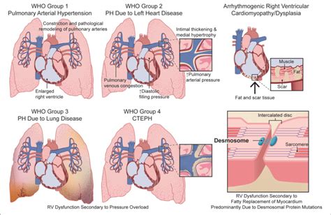 Comparison Of The Etiologies Of Right Ventricular Dysfunction In Download Scientific Diagram