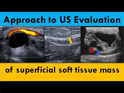 Approach To Ultrasound Evaluation Of Superficial Soft Tissue Mass Youtube