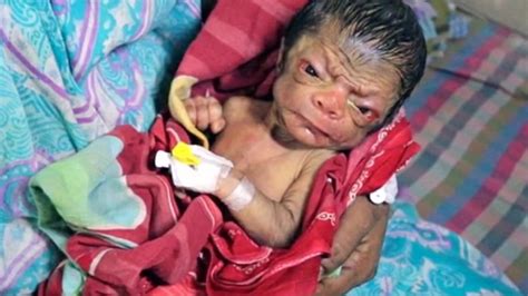 Baby Born As ‘old Man In Case Of ‘real Life Benjamin Button Photos