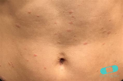 Online Dermatology - Pityriasis Rosea