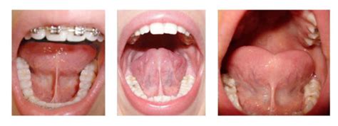 What Is A Functional Frenuloplasty Faceology