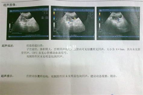 B超单子有这三个数据一般是女孩，看不懂的孕妈好可惜！ 柚鼠知识