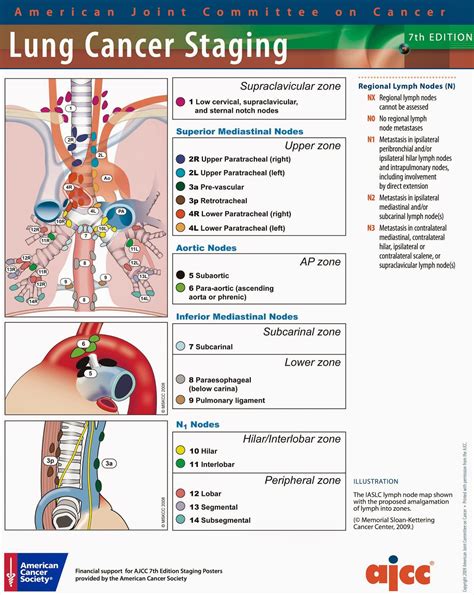 Stage 2 Cancer Lymph Nodes