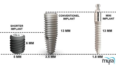 Mini Dental Implant Definition Advantages Disadvantages Average Cost