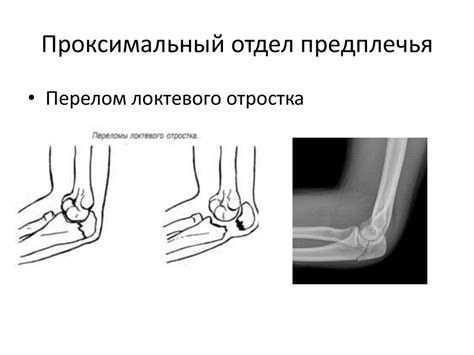 Повреждения кисти и предплечья - презентация онлайн