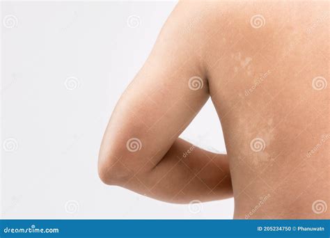 Tinea Versicolor Pityriasis Versicolor Skin Infection On The Back Is A