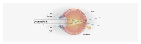 focus  short sightedness patrick menzies