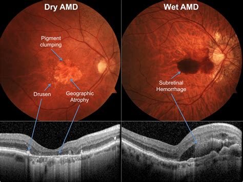 Conditions Needing Intravitreal Injections Mr Kirti M Jasani