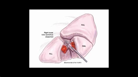 Sts University Course Vats Lobectomy Youtube