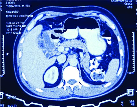 Showing Type 2 Gallbladder Perforation On Cect Abdomen Download