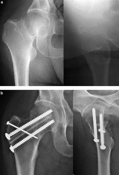 A Anteroposterior Ap And Lateral Pre Operative Radiographs Of A Download Scientific Diagram