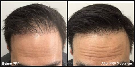 Prp Before And Afters — Village Dermatology