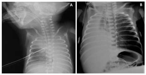 Strategies To Improve Neonatal Intubation Safety By Preventing