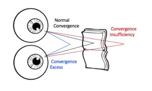 CONVERGENCE excess - Toronto Concussion Clinic