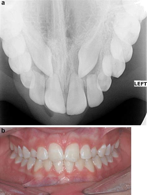 A Standard Maxillary Occlusal Radiograph With Resorbed Lateral And