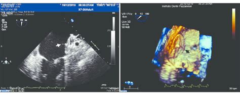 Imagens Ecocardiogr Ficas Bidimensional Esquerda E Tridimensional