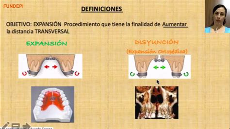 Disyunci N Maxilar En Edad Infantil Adolescente Y Adulta Youtube