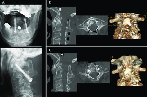 Postoperative Radiographs And Ct Scans A Radiographs Revealed