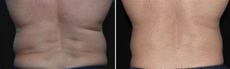 Velashape Before And After Vivalaser For You For All For Beauty