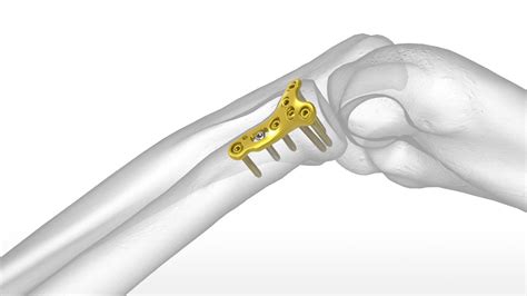 Acumed Radial Head Plating System Medical Optical