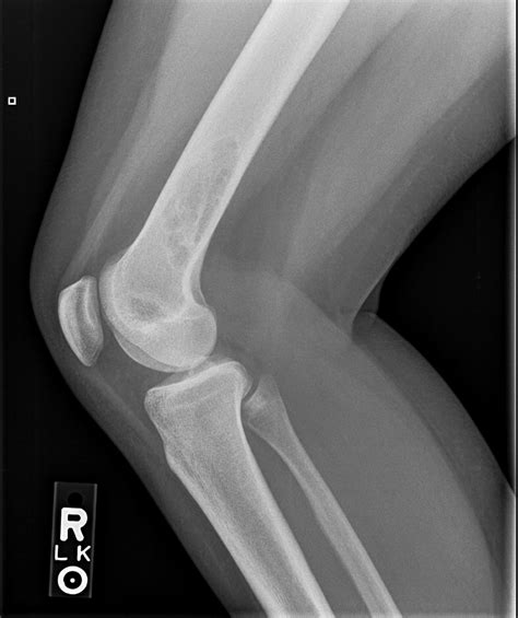 Non Ossifying Fibroma Radiology Case