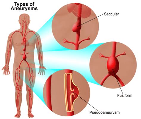 Aortic Aneurysm: Causes, Symptoms And Treatment