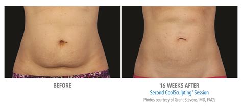 CoolScultping Fat Reduction Treatment Gainesville Before After Pictures