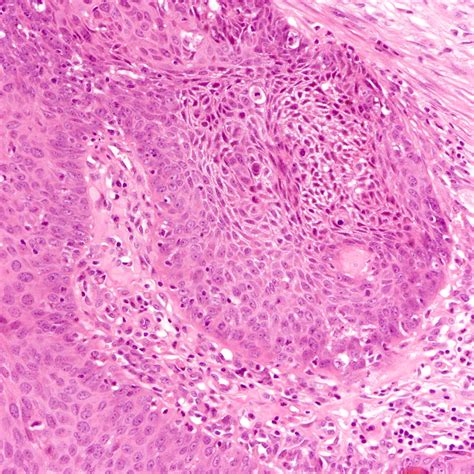 Squamous Cell Carcinoma Breast Pathology Outlines