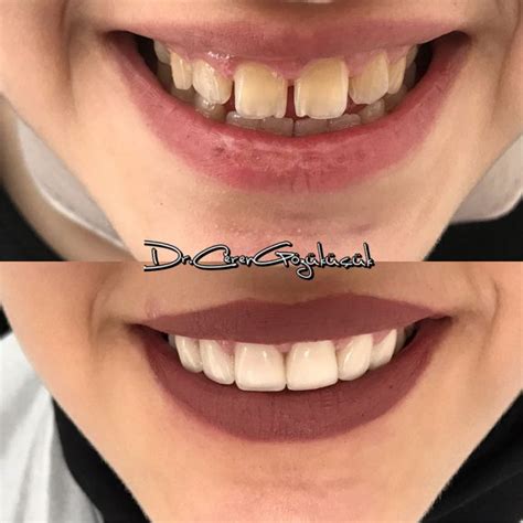 Zirkonyum Kaplama Ceren Dental Clinic