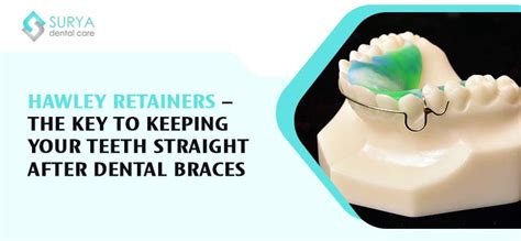 Hawley Retainers — The Key To Keeping Your Teeth Straight After Dental Braces By Mihika Vasant