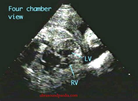 Complete Heart Block With Congenital Heart Disease Chd