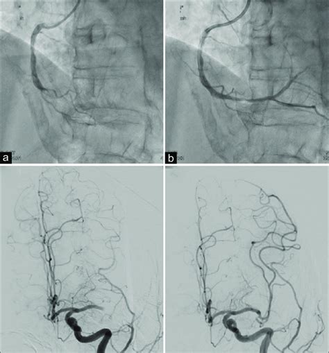 Percutaneous Coronary Intervention PCI And Mechanical Thrombectomy