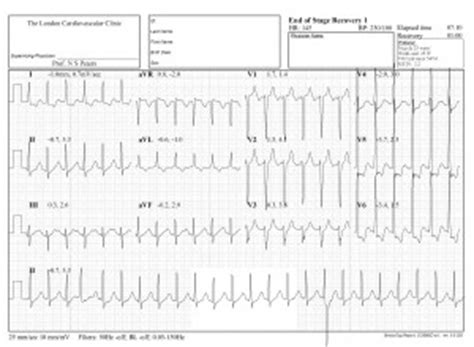 Exercise Tolerance Testing (ETT) - London Cardiovascular Clinic