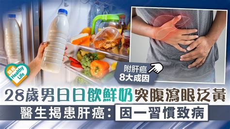 食用安全︳28歲男日日飲鮮奶突腹瀉眼泛黃 醫生揭患肝癌：因一習慣致病 ︳附肝癌8大成因 晴報 健康 腫瘤及癌症 D221007