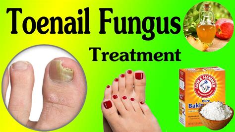 Simple And Effective Home Remedy For Toenail Fungus How To Cure