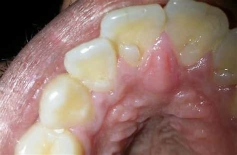 Roof of Mouth Hurts: Causes and Treatment | IYTmed.com