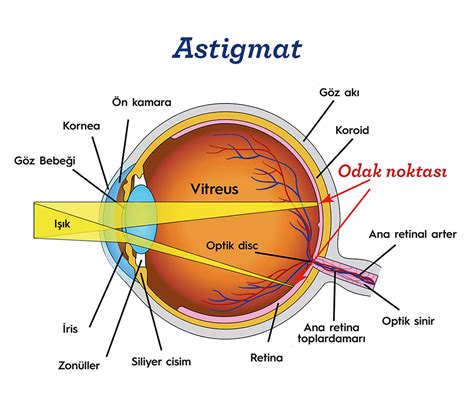 Miyopi nedir Miyopi belirtileri nelerdir Berrak Optik Online Alışveriş