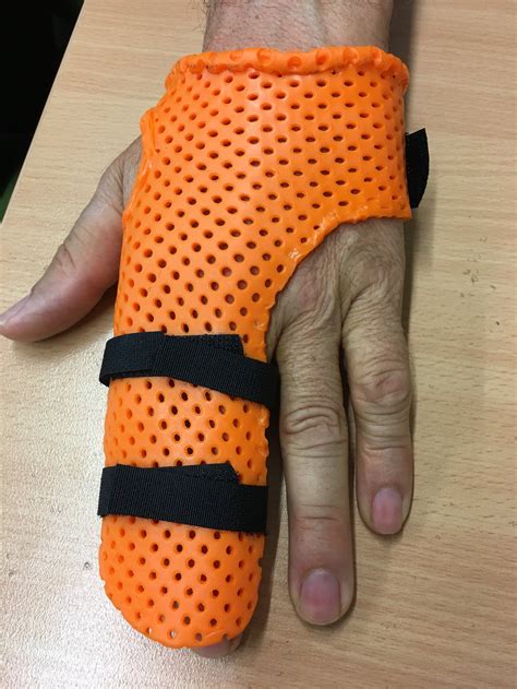 Radial Gutter Splint Pattern