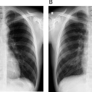 Chest Radiography Of Case 1 Patient Chest Radiography Of Case 1