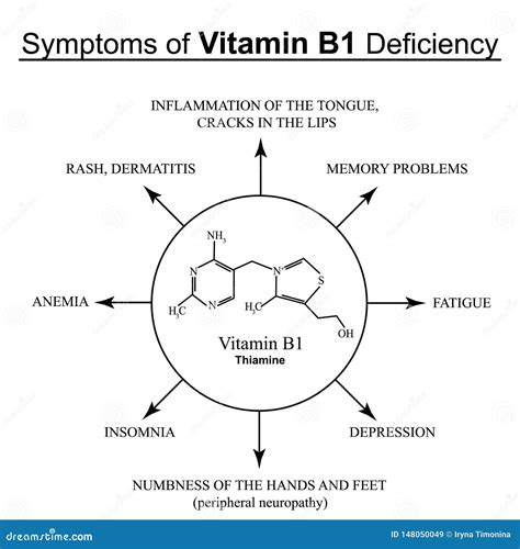 S Ntomas De La Deficiencia De La Vitamina B1 Infograf A Ejemplo Del