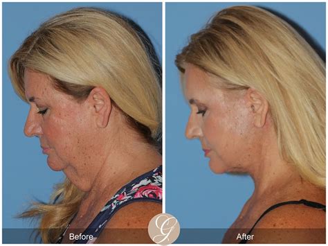 Deep Plane Facelifts Before After Photos From Dr Kevin Sadati