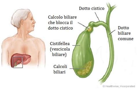 Come riconoscere i calcoli alla cistifellea Vivere più sani