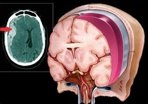 Hematoma subdural la hemorragia que llevó a la muerte a Akira Toriyama