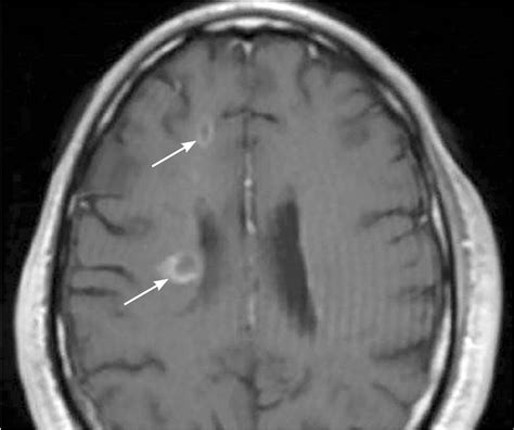 Multiple Sclerosis A Primary Care Perspective Aafp