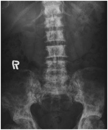 Systematic Approach Of Sclerotic Bone Lesions Basis On Imaging Findings