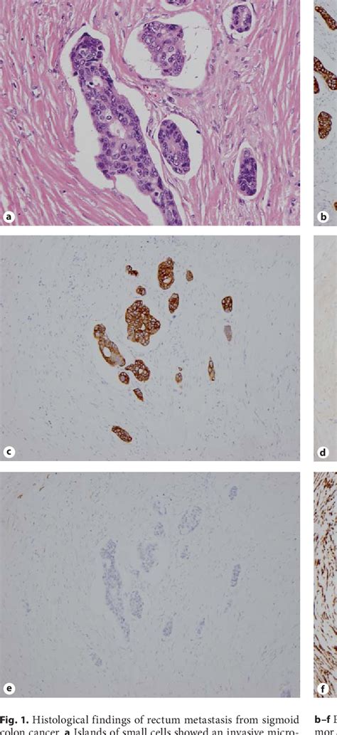 Vaginal Stump Metastasis From Sigmoid Colon Cancer Semantic Scholar