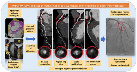 Frontiers Commentary Plaque Features And Epicardial Fat Volume For