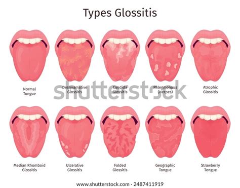 Glossitis Scarlet Tongue Disease Types Human Stock Vector Royalty Free