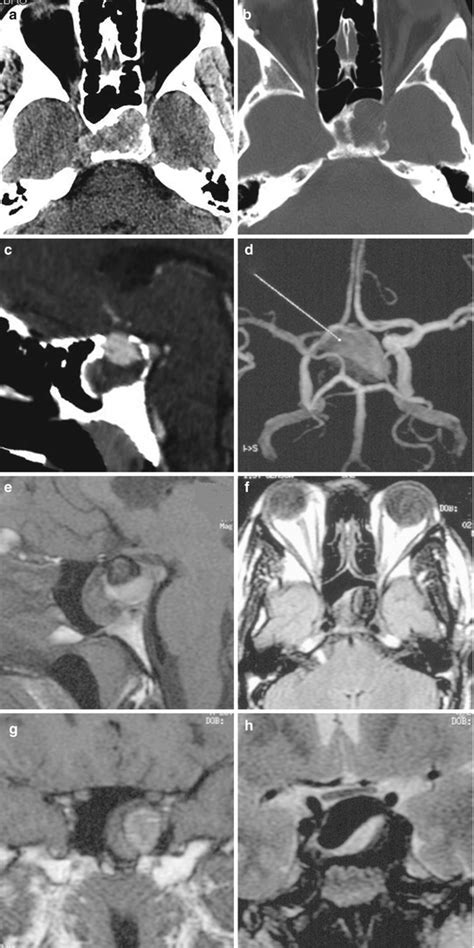 Cerebral Aneurysms With Intrasellar Extension Neupsy Key